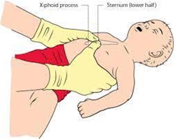 CPR پیشرفته نوزاد